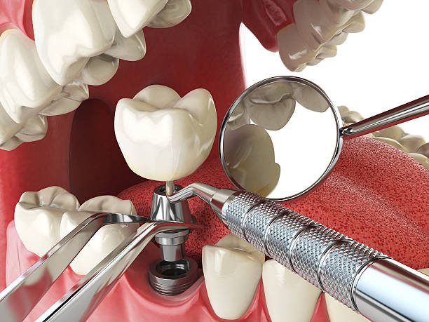 Best Emergency Treatment for Dental Infections or Abscesses in Oakbrook Terrace, IL